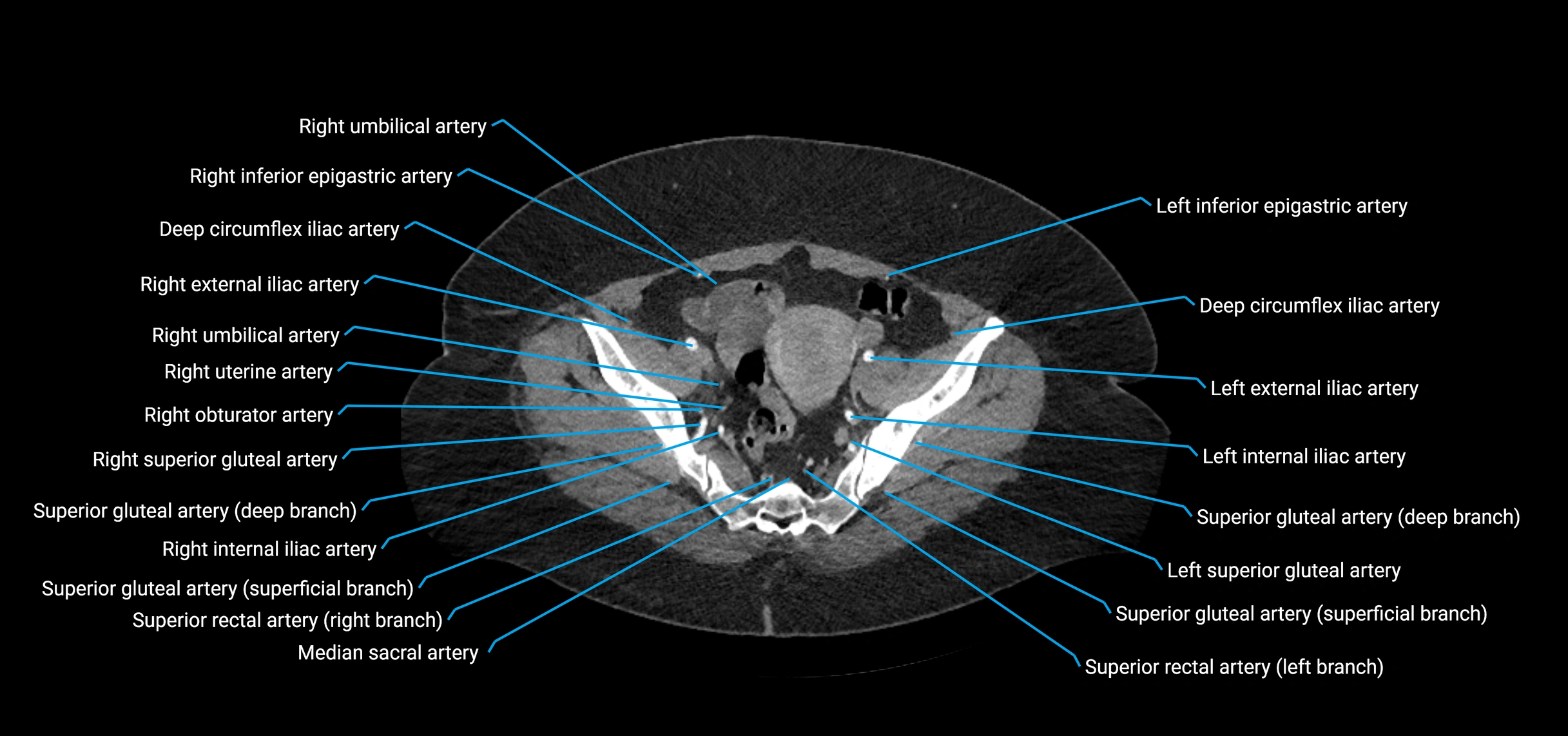 CTA abdomen axial cross sectional anatomy labelled image_209 (2).webp